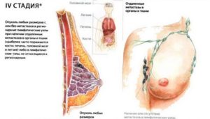 Третья стадия рака молочной железы