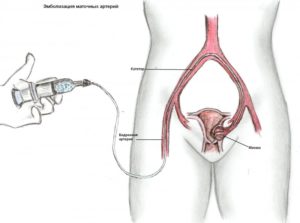 Эма миомы матки