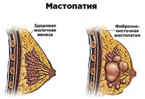 Болит молочная железа уплотнений нет