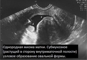Субмукозная миома матки и беременность