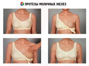 Бюстгальтер после удаления молочной железы