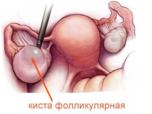 Фолликулярная киста правого яичника можно ли забеременеть