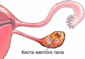 Разрыв желтого тела яичника