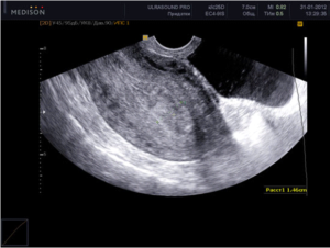 Узи матки и яичников подготовка
