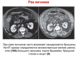 Рак яичников канцероматоз