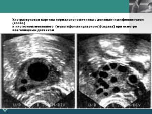 Сколько фолликулов должно быть в яичнике при эко