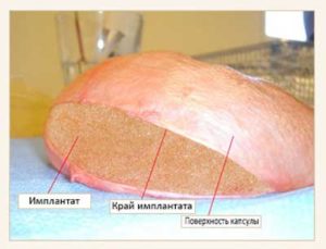 Контрактура импланта молочной железы