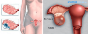 Двухкамерная киста яичника что это такое