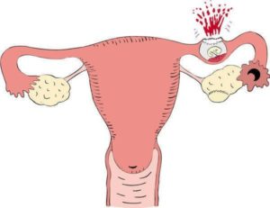 Почему болит левый яичник при беременности