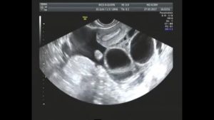 Беременность после гиперстимуляции яичников
