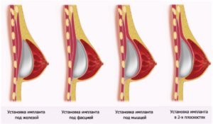 Импланты молочных желез