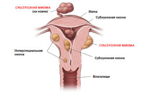 Миома субсерозная и беременность