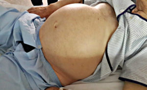 Асцит брюшной полости при онкологии яичников