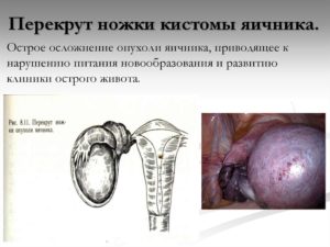 Перекрут кисты яичника симптомы