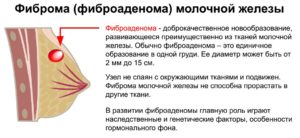 Что такое фиброма молочной железы