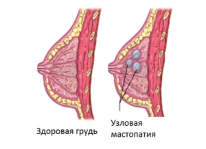 Болит молочная железа уплотнений нет