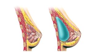 Аугментация молочных желез