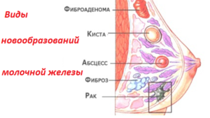 Фиброз молочной железы что это такое