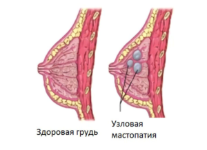 Болезни молочных желез у женщин