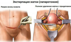 Операция по удалению матки и яичников