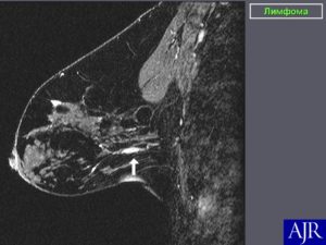 Лимфома молочной железы
