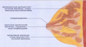 Когда начинает болеть молочные железы при беременности