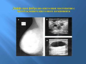 Диффузные изменения молочной железы что это такое