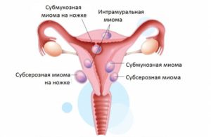 Субсерозно интрамуральная миома матки