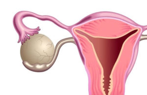 Фолликулярная киста яичника задержка месячных