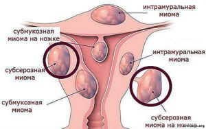 Миома интрамуральная и беременность