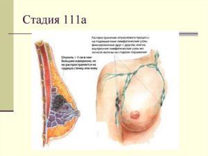Лимфоузлы при раке молочной железы