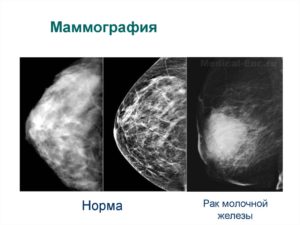 Когда делать маммографию молочных желез на какой день цикла