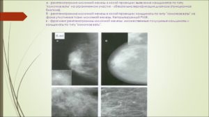 Фиброаденома с кальцинатами молочной железы