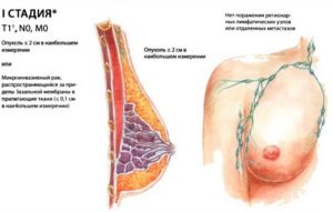 Первая стадия рака молочной железы