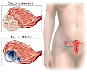 Рак яичника прогноз выживания