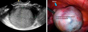 Киста левого яичника функциональная лечение