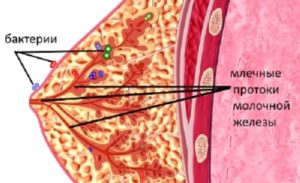 Воспаление протока молочной железы