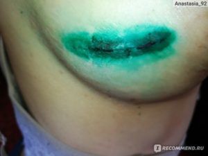 После удаления фиброаденомы молочной железы через сколько можно беременеть