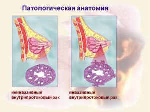 Патанатомия рак молочной железы