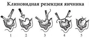 Клиновидная резекция яичников