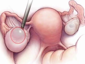 Фолликулярная киста яичника лечение народными средствами