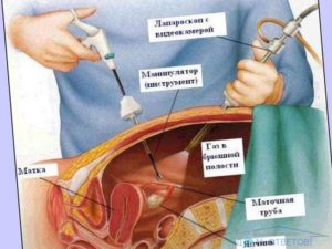 Дают ли инвалидность при удалении матки и яичников