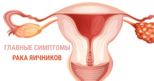 Признаки рака яичника на ранней стадии