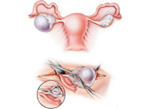 Нарушение функции яичников у женщин