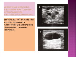 Диффузный фам молочных желез с преобладанием фиброзного компонента