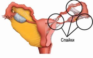 Спайки на яичниках