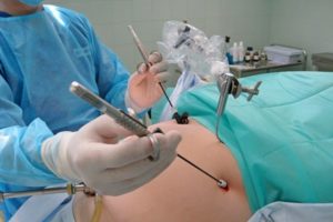Операция лапароскопия яичников