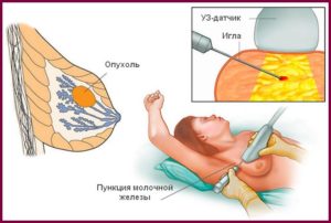 Пунктирование кисты молочной железы