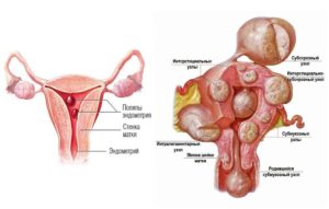 Аденомиоз и миома матки это одно и тоже