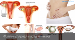 Как лечить яичники у женщин народными средствами